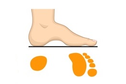 Hoher Fußrücken kann Symptom für Hohlfuß sein