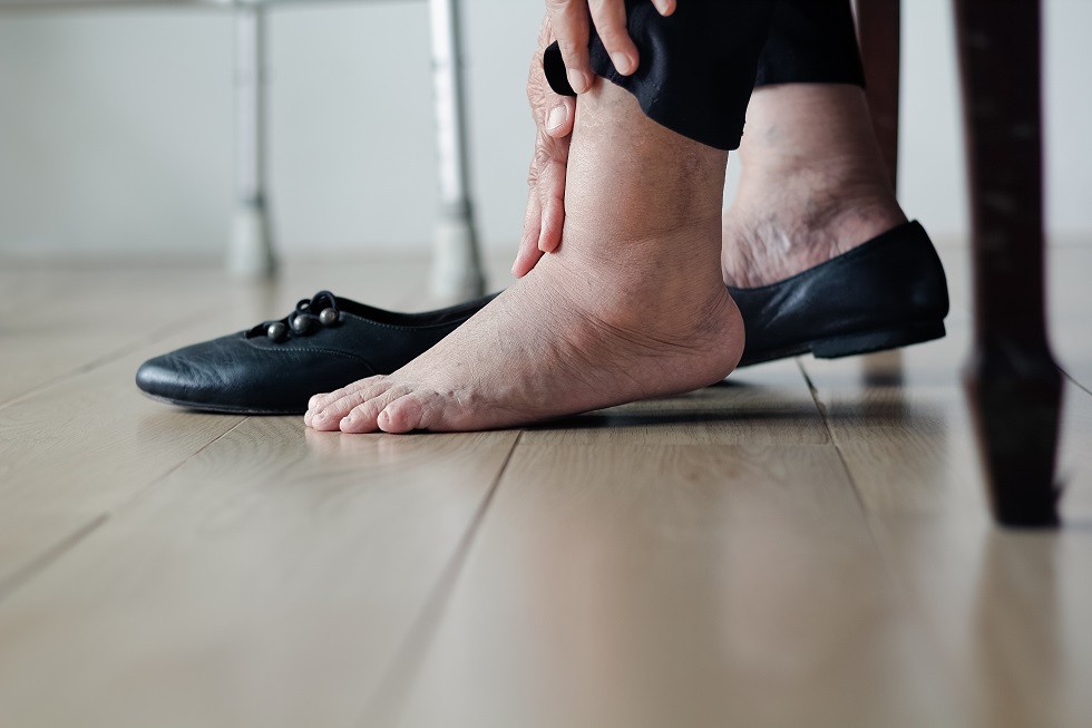 Stamp out swelling in the legs: Tips to prevent swollen feet