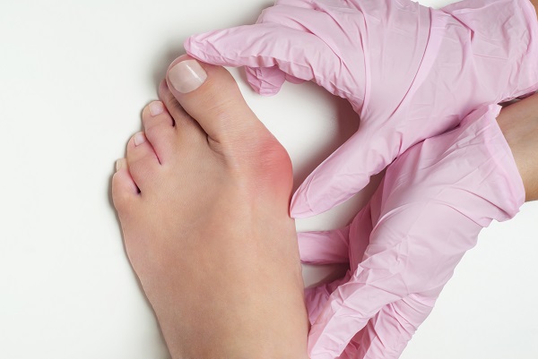 How to straighten a hallux valgus without surgery