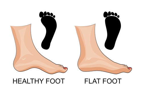 Flat foot - The Original Foot Alignment Socks