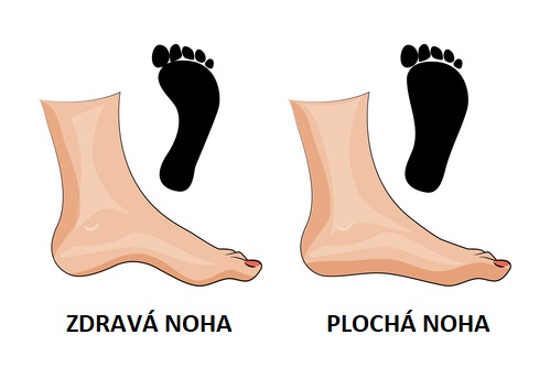 Plochá noha