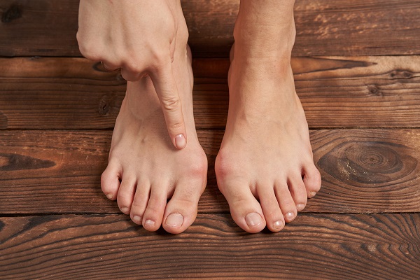 Bothered by a bunion? Treatment, symptoms and the most common causes