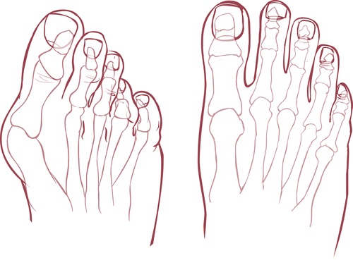 Hallux Valgus